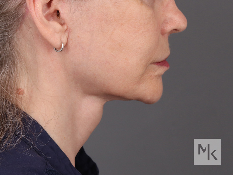 Facelift Before and After | Dr. Michael Kim