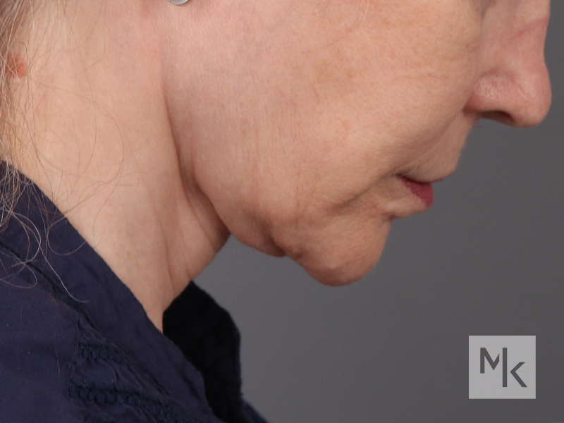 Facelift Before and After | Dr. Michael Kim