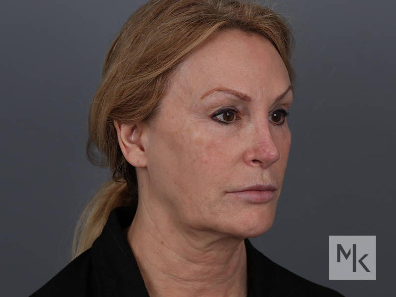 Facelift Before and After | Dr. Michael Kim