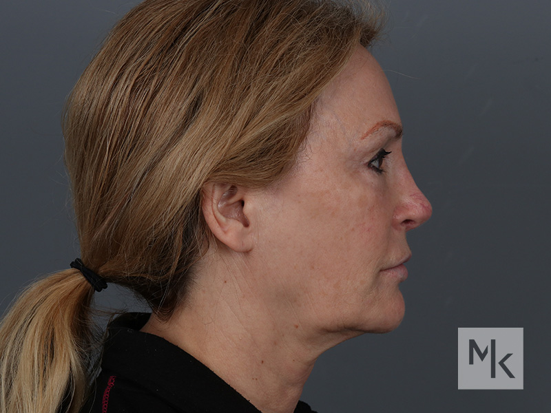 Facelift Before and After | Dr. Michael Kim