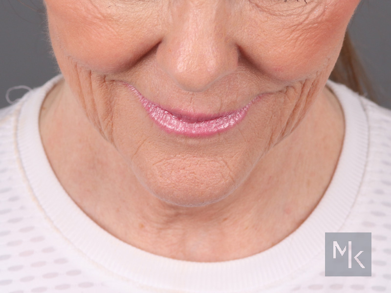 Facelift Before and After | Dr. Michael Kim