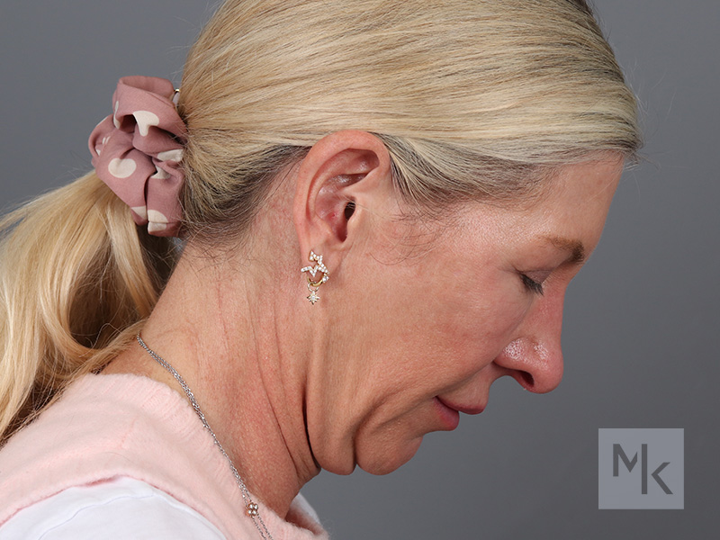 Facelift Before and After | Dr. Michael Kim