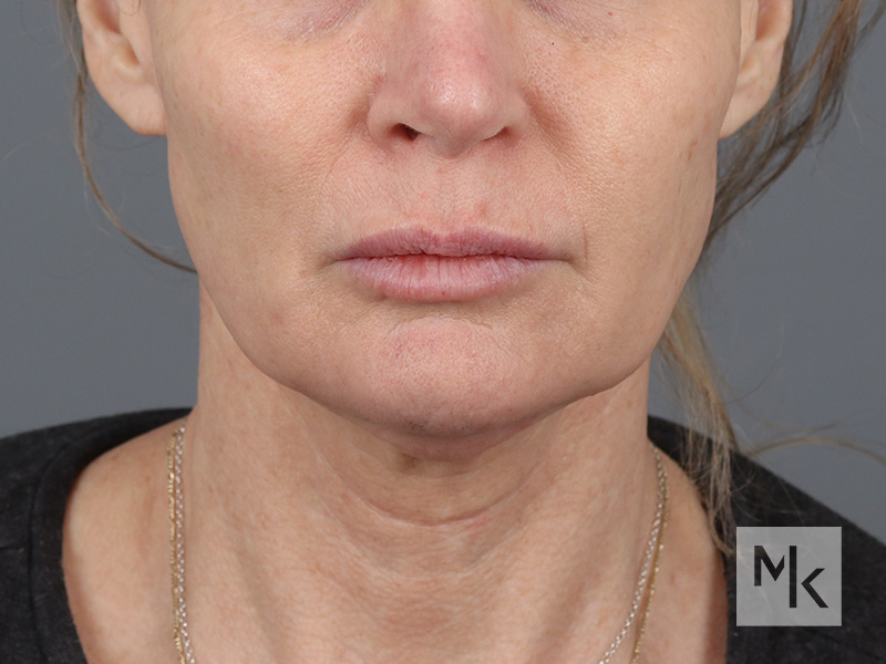 Facelift Before and After | Dr. Michael Kim