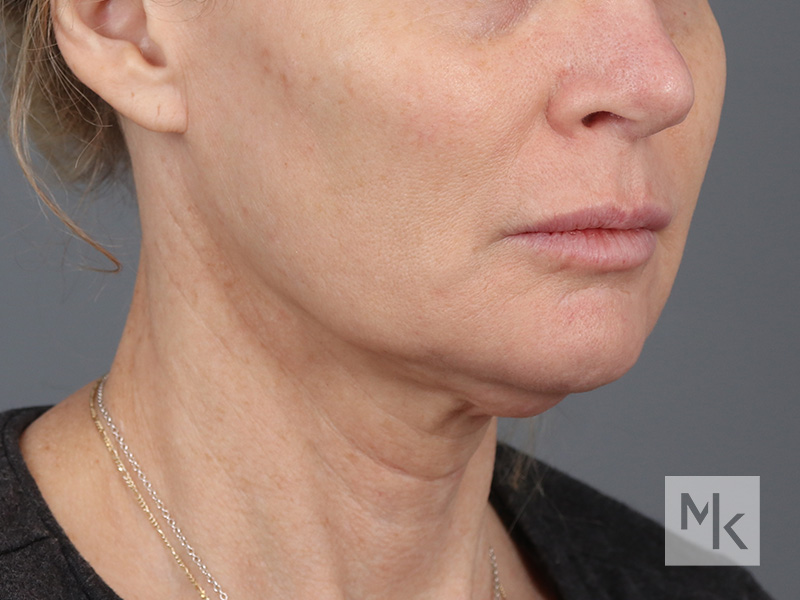 Facelift Before and After | Dr. Michael Kim