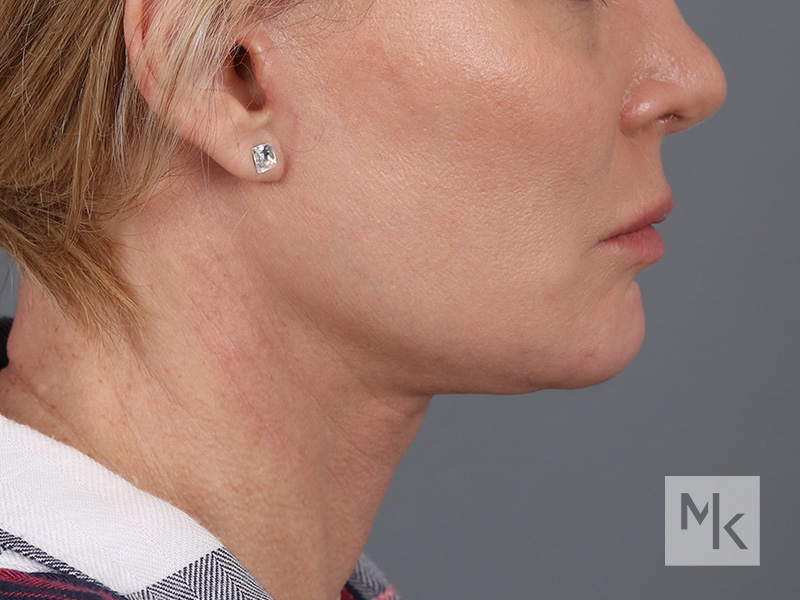 Facelift Before and After | Dr. Michael Kim