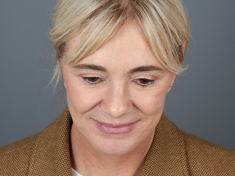 Facelift Before and After | Dr. Michael Kim