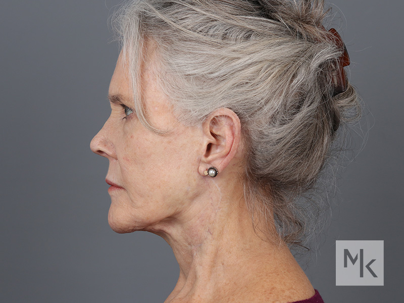 Facelift Before and After | Dr. Michael Kim