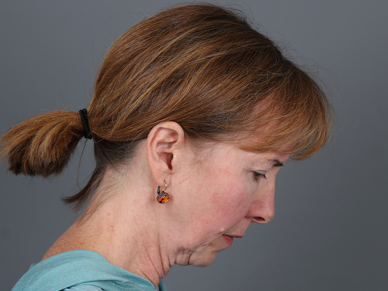 Facelift Before and After | Dr. Michael Kim