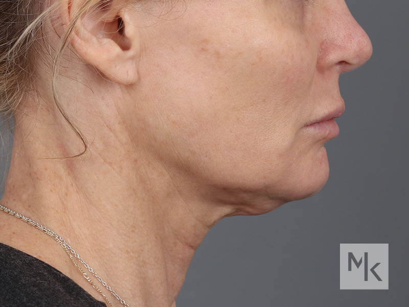 Facelift Before and After | Dr. Michael Kim