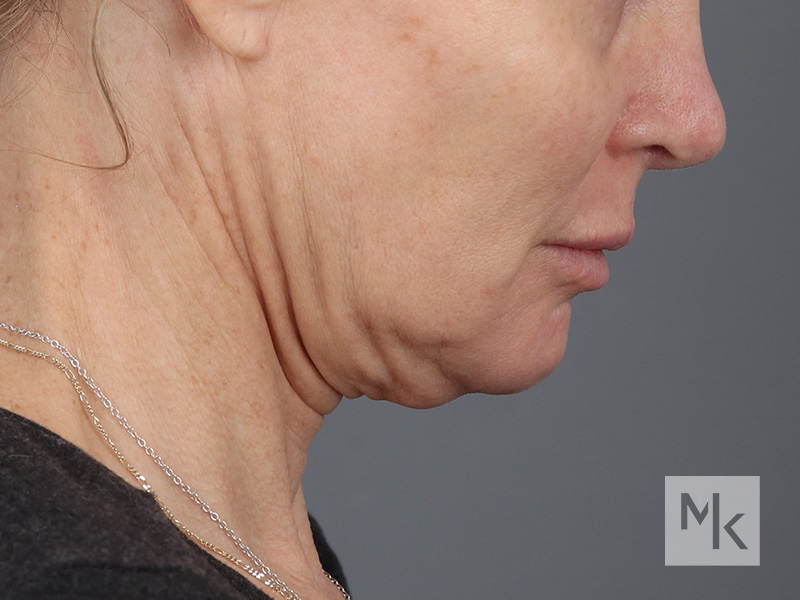 Facelift Before and After | Dr. Michael Kim