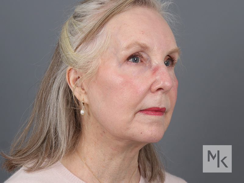 Facelift Before and After | Dr. Michael Kim