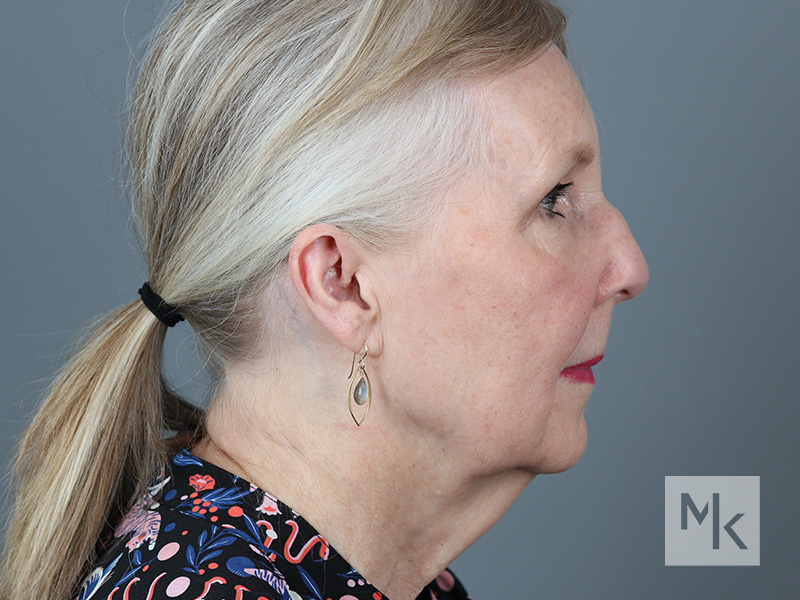 Facelift Before and After | Dr. Michael Kim