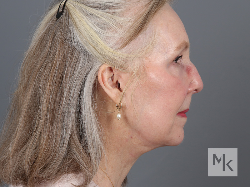 Facelift Before and After | Dr. Michael Kim