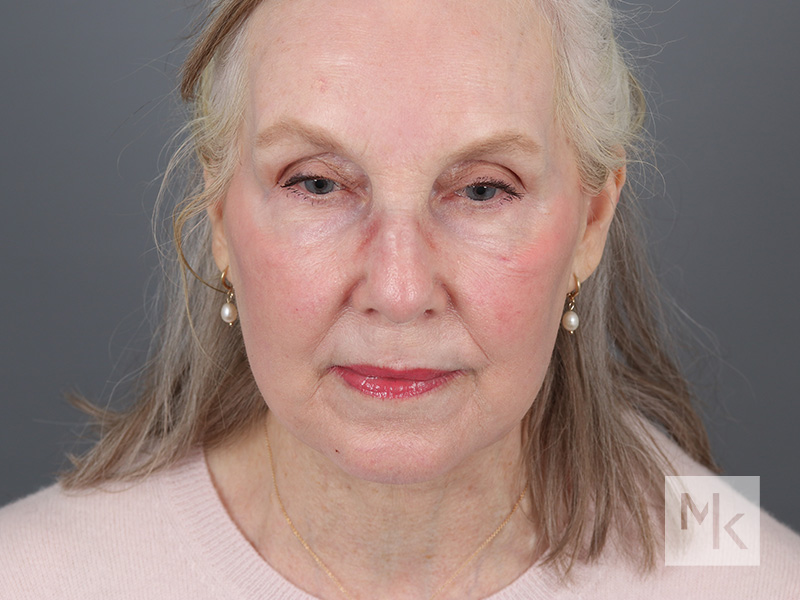 Facelift Before and After | Dr. Michael Kim