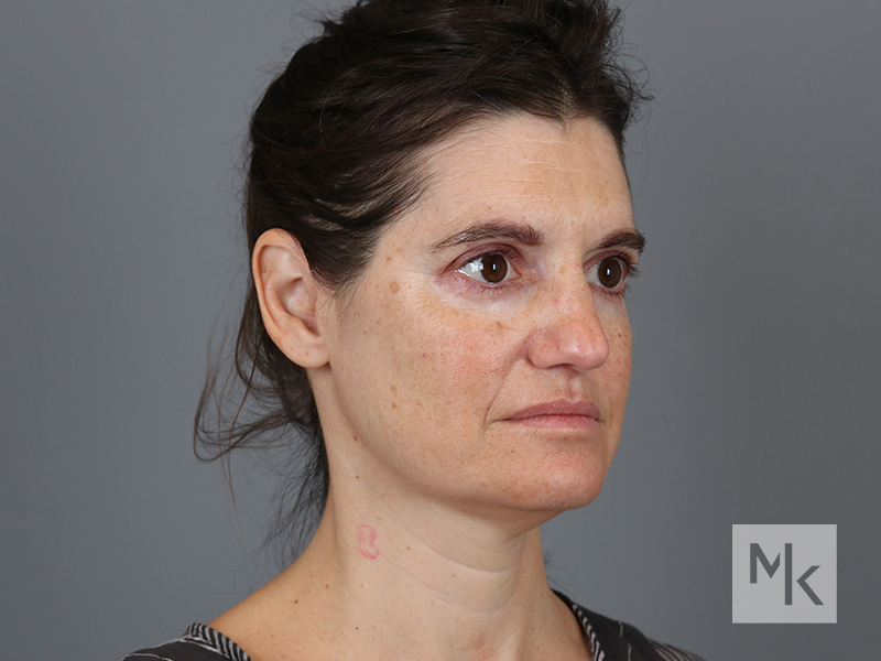 Facelift Before and After | Dr. Michael Kim