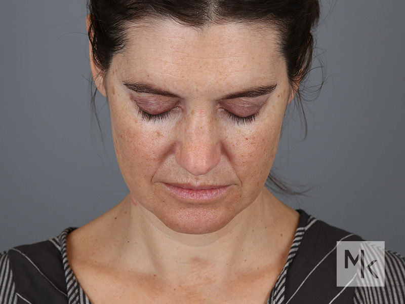 Facelift Before and After | Dr. Michael Kim