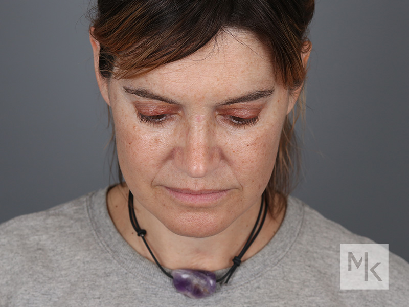 Facelift Before and After | Dr. Michael Kim