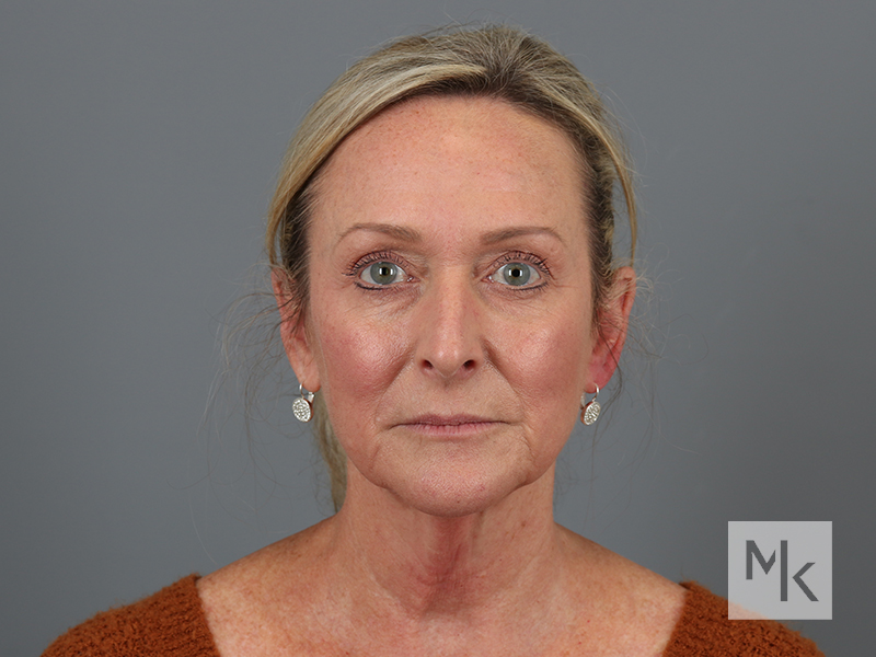 Facelift Before and After | Dr. Michael Kim