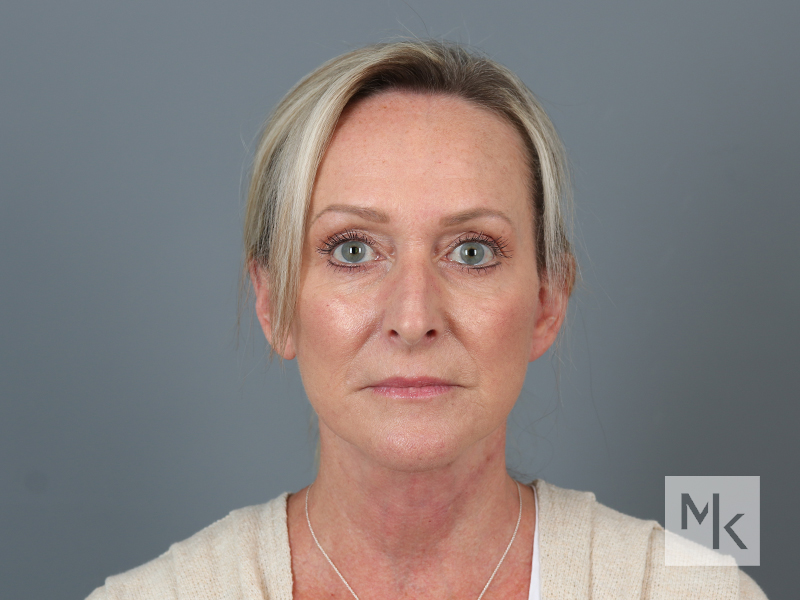 Facelift Before and After | Dr. Michael Kim