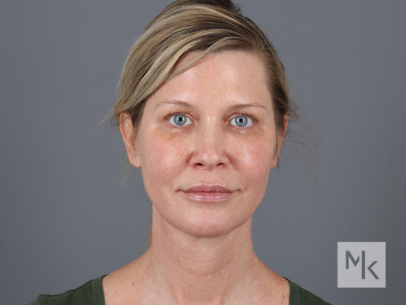 Facelift Before and After | Dr. Michael Kim