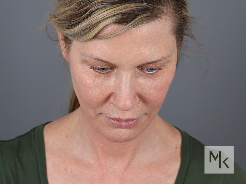 Facelift Before and After | Dr. Michael Kim