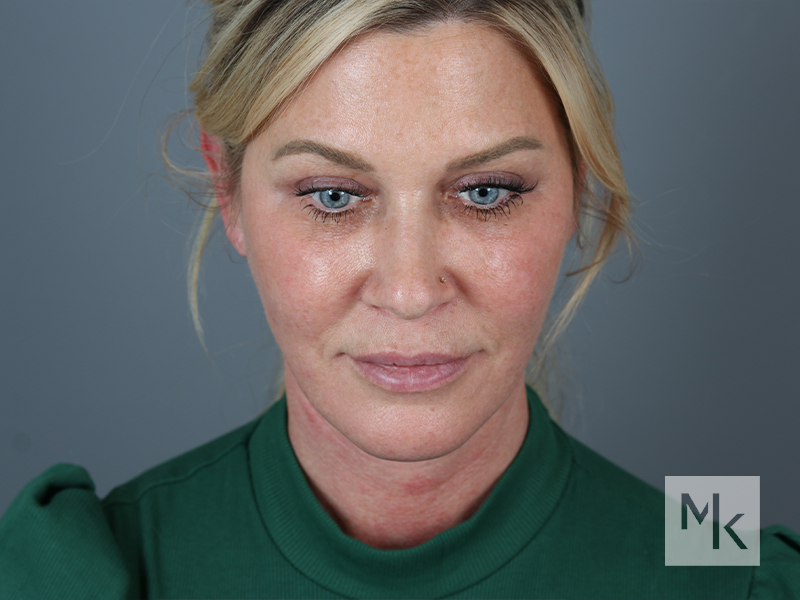 Facelift Before and After | Dr. Michael Kim