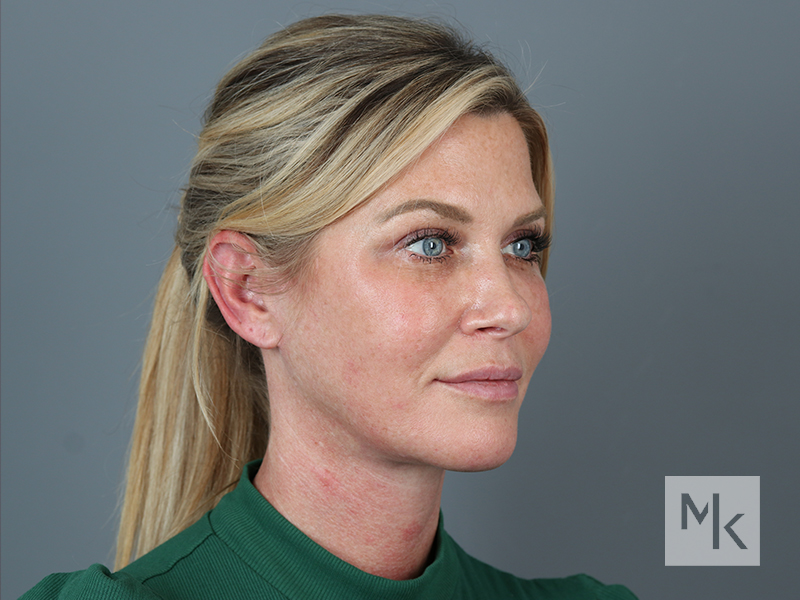Facelift Before and After | Dr. Michael Kim
