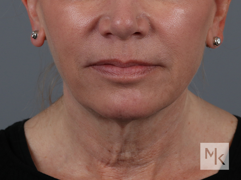 Facelift Before and After | Dr. Michael Kim