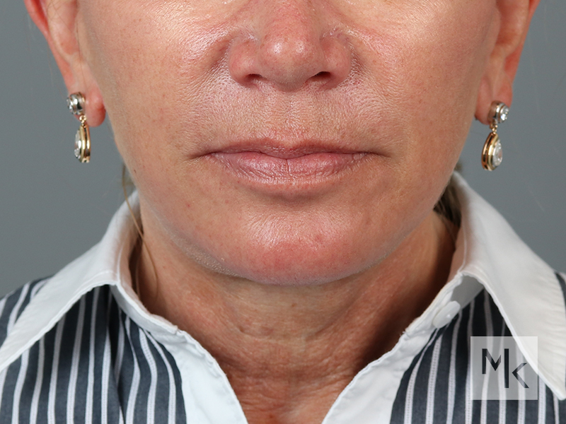 Facelift Before and After | Dr. Michael Kim
