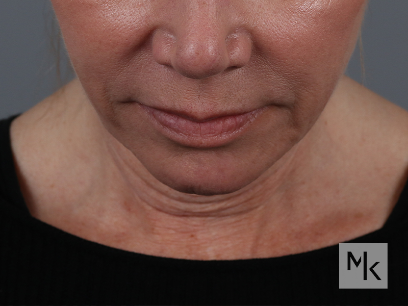 Facelift Before and After | Dr. Michael Kim