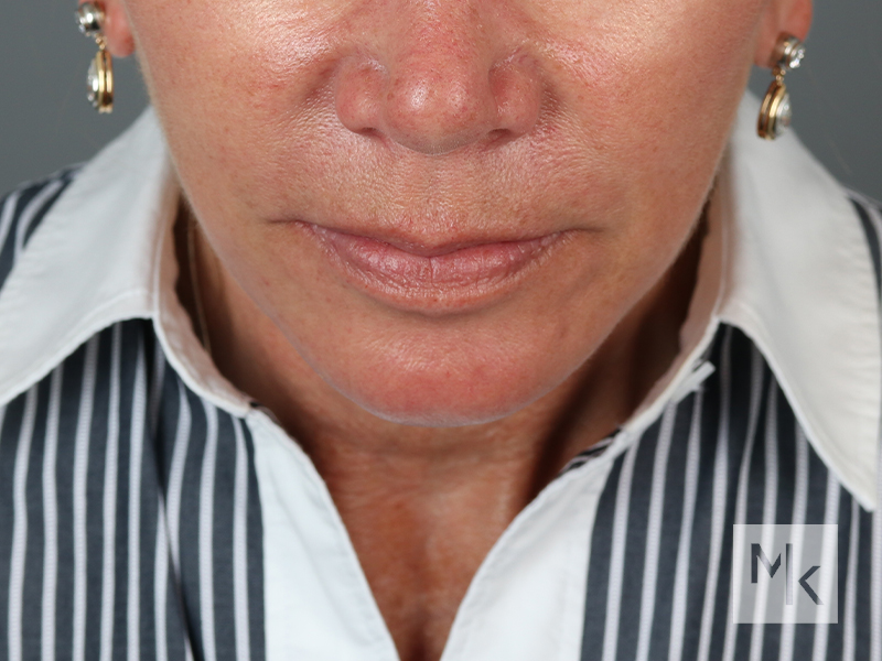 Facelift Before and After | Dr. Michael Kim