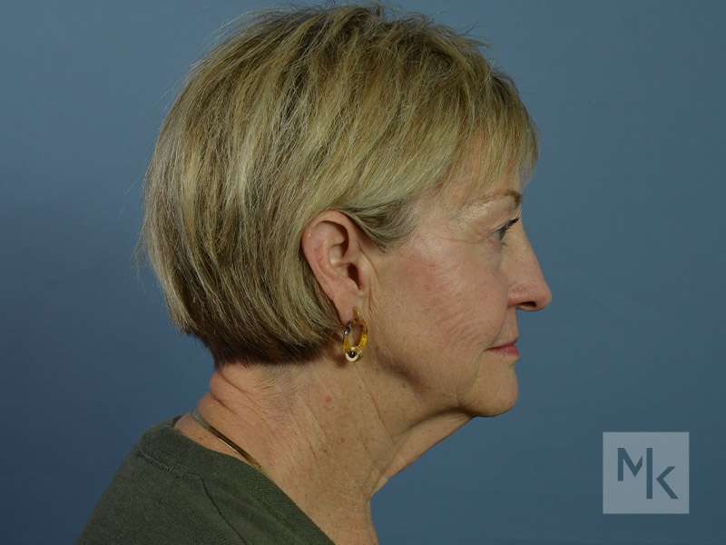 Facelift Before and After | Dr. Michael Kim