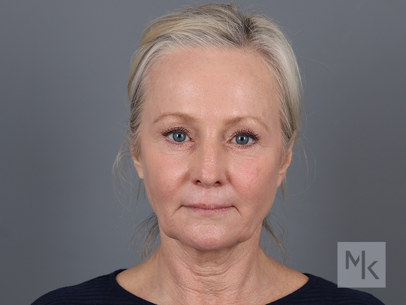 Facelift Before and After | Dr. Michael Kim