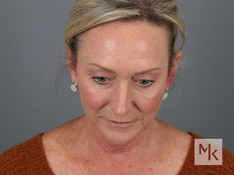 Facelift Before and After | Dr. Michael Kim
