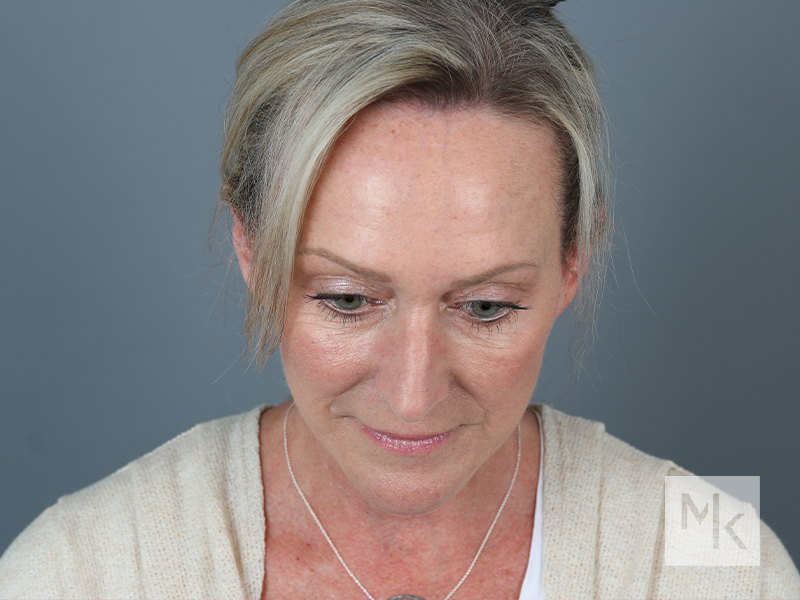 Facelift Before and After | Dr. Michael Kim