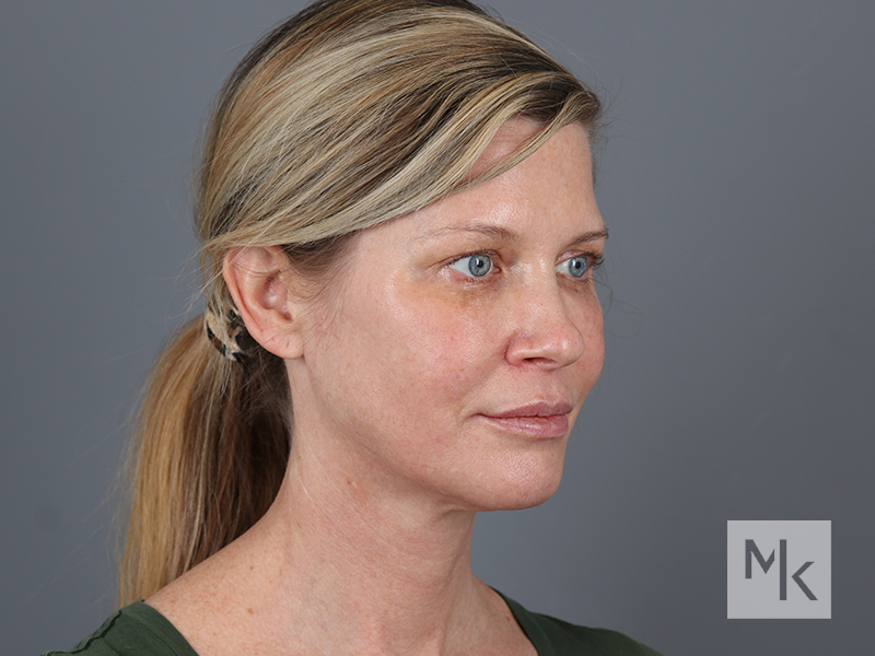 Facelift Before and After | Dr. Michael Kim