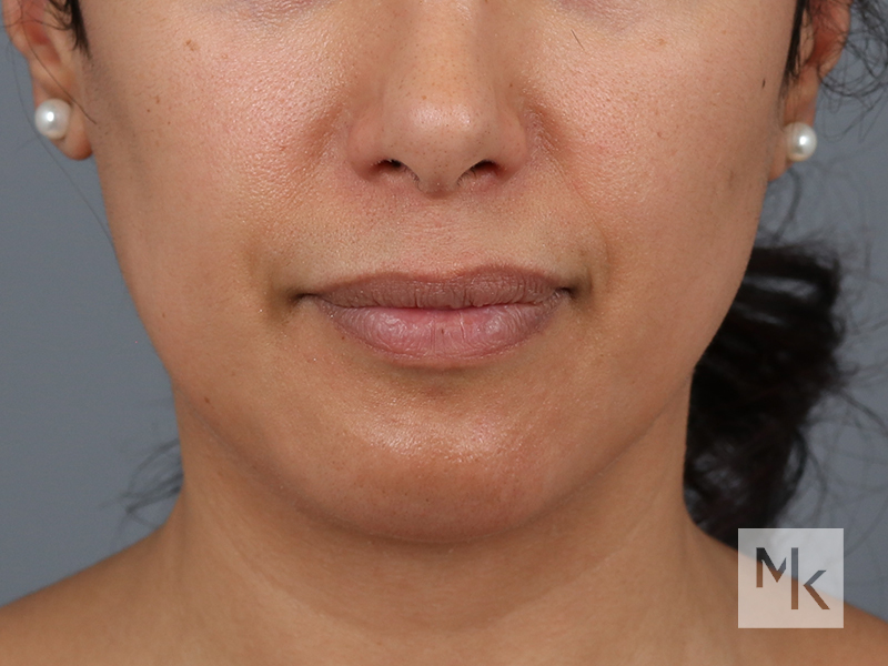 Facelift Before and After | Dr. Michael Kim