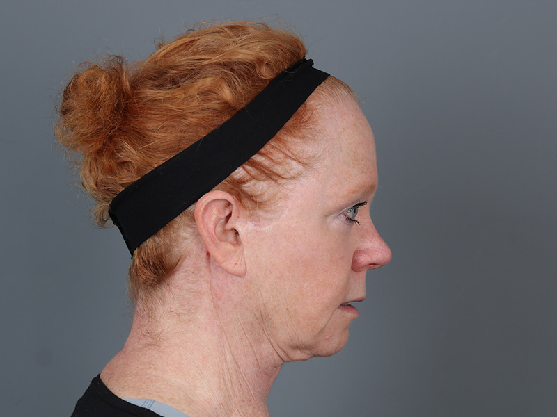 Hairline Lowering Before and After | Dr. Michael Kim