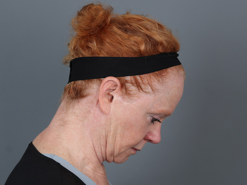 Hairline Lowering Before and After | Dr. Michael Kim