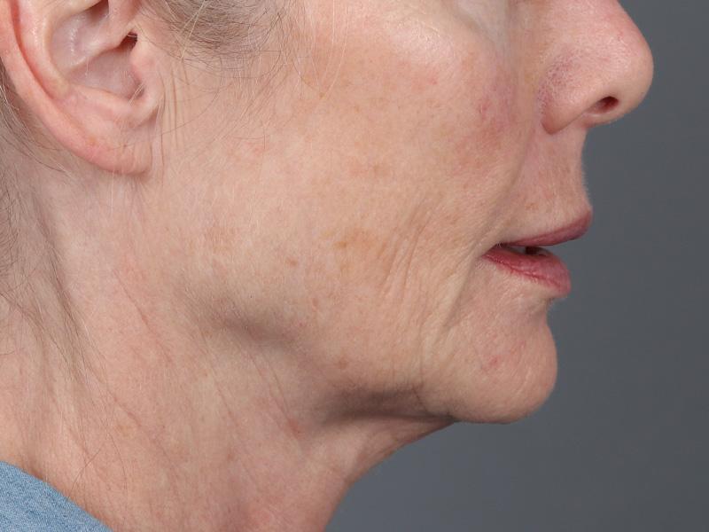Laser Resurfacing Before and After | Dr. Michael Kim