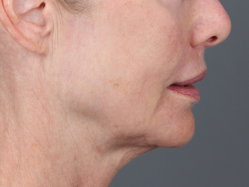 Laser Resurfacing Before and After | Dr. Michael Kim