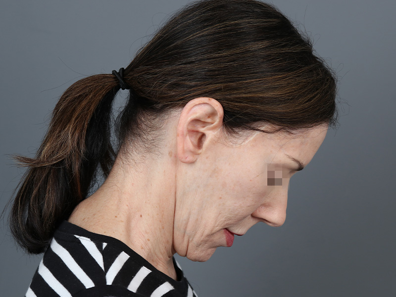 Laser Resurfacing Before and After | Dr. Michael Kim