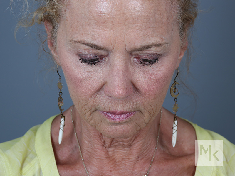 Laser Resurfacing Before and After | Dr. Michael Kim