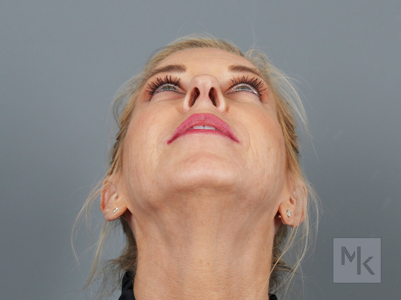 Laser Resurfacing Before and After | Dr. Michael Kim