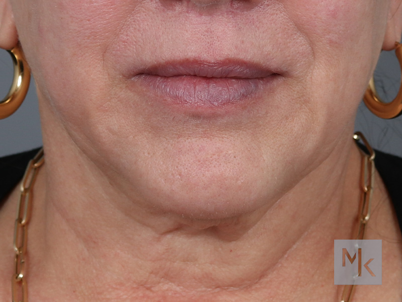 Lip Lift Before and After | Dr. Michael Kim