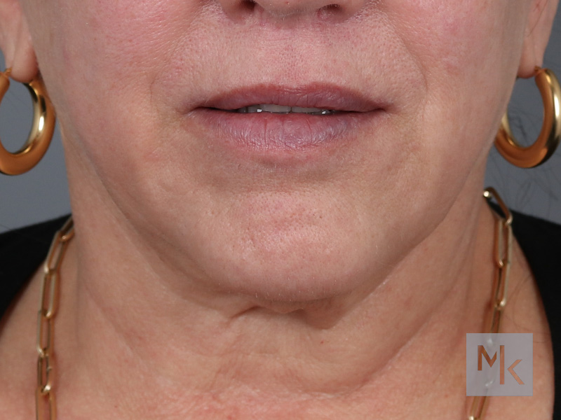 Lip Lift Before and After | Dr. Michael Kim