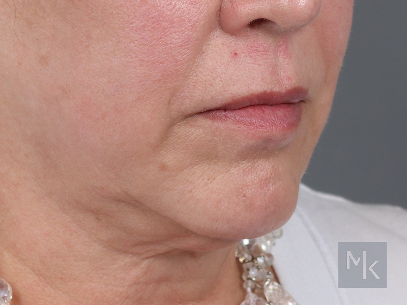 Lip Lift Before and After | Dr. Michael Kim