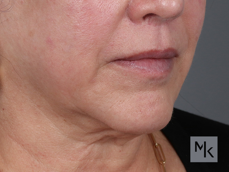 Lip Lift Before and After | Dr. Michael Kim