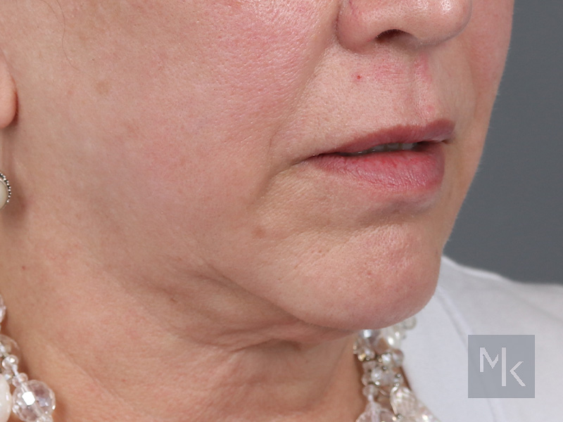 Lip Lift Before and After | Dr. Michael Kim