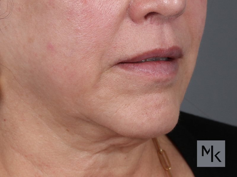 Lip Lift Before and After | Dr. Michael Kim